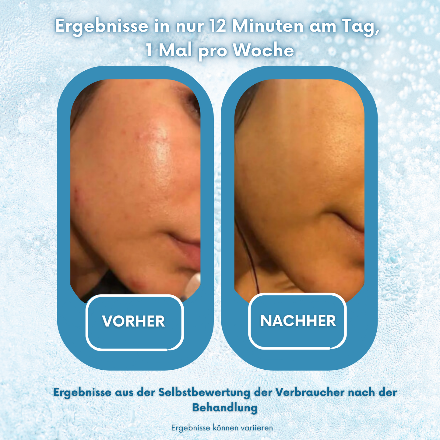 PoreX Original – Deine Haut, nur besser