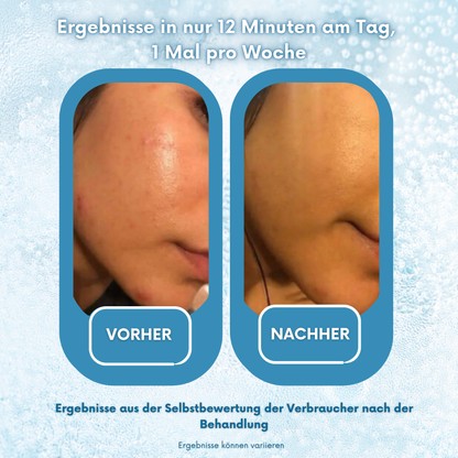PoreX Original – Deine Haut, nur besser